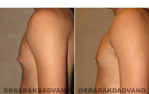 Gynecomastia. Before and After Treatment Photos - male - left side view (patient - 53)