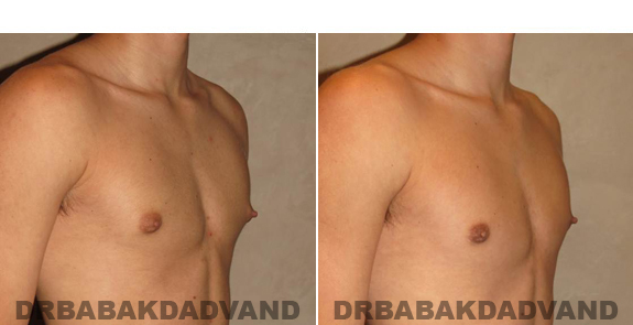 Gynecomastia. Before and After Treatment Photos - male - right side oblique view (patient - 53)