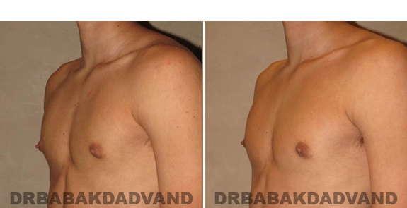 Gynecomastia. Before and After Treatment Photos - male - left side view (patient - 53)