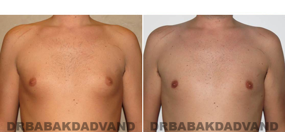 Gynecomastia. Before and After Treatment Photos - male - front view (patient - 54)