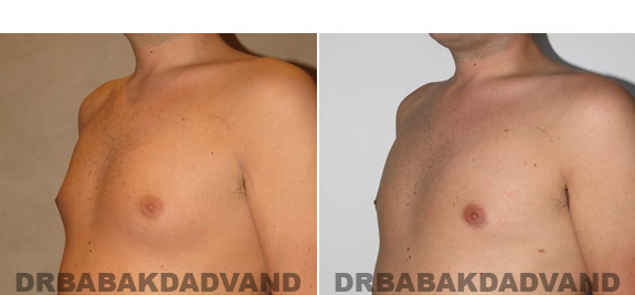Gynecomastia. Before and After Treatment Photos - male - left side oblique view (patient 54)