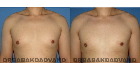 Gynecomastia. Before and After Treatment Photos - male - front view (patient - 55)