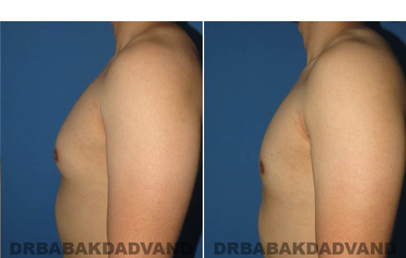 Gynecomastia. Before and After Treatment Photos - male - left side view (patient - 55)