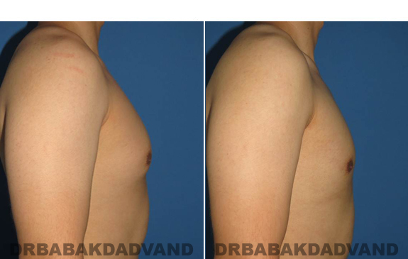 Gynecomastia. Before and After Treatment Photos - male - right side view (patient - 55)