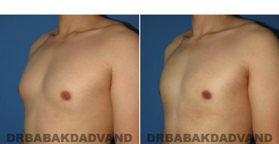 Gynecomastia. Before and After Treatment Photos - male - left side oblique view (patient 55)