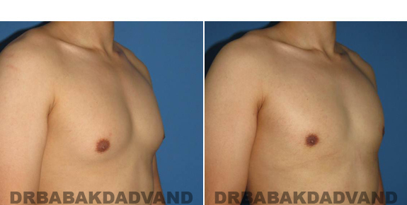 Gynecomastia. Before and After Treatment Photos - male - right side oblique view (patient - 55)