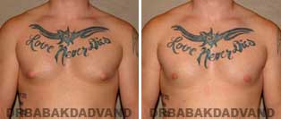 Before and After Treatment Photos: 24 year old Male, puffy nippels