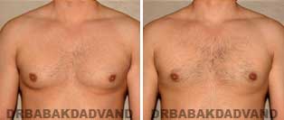 Before and After Treatment Photos: 32 year old Male