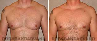 Before and After Treatment Photos: 39 year old patient