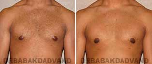 Before and After Treatment Photos: 23 year old patient