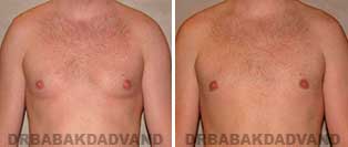 Before and After Treatment Photos: 28 year old male, gynecomastia surgery
