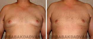 Before and After Treatment Photos: 35 year old male, gynecomastia surgery