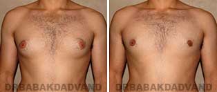 Before and After Treatment Photos: 22 year old male, gynecomastia surgery