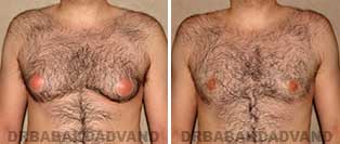 Before and After Treatment Photos: gynecomastia surgery - 28 year old male