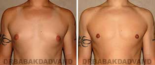 Before and After Treatment Photos: gynecomastia surgery - 27 year old male