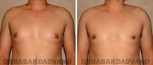 Before and After Treatment Photos: gynecomastia surgery - 27 year old patient