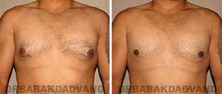 Before and After Treatment Photos: gynecomastia surgery - 28 year old patient