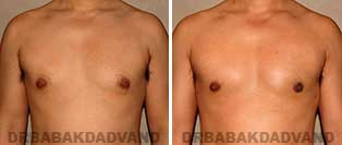 Before and After Treatment Photos: gynecomastia surgery-36 year old patient