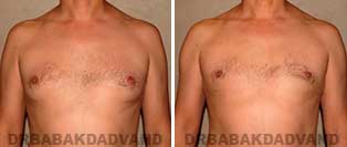Before and After Treatment Photos: gynecomastia surgery-40 year old patient