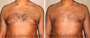 Before and After Treatment Photos: gynecomastia surgery- 33 year old patient