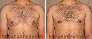Before and After Treatment Photos: gynecomastia surgery- 26 year old patient