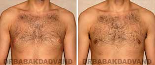 Before and After Treatment Photos: 24 year old Male, left sided gynecomastia