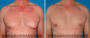 Before and After Treatment Photos: gynecomastia surgery - 35 year old patient
