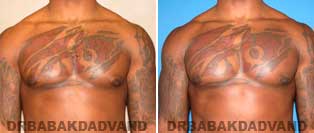 Before and After Treatment Photos: Gynecomastia Surgery: 27 year old patient