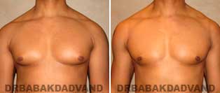 Before and After Treatment Photos: Gynecomastia Surgery: 50 year old, patient