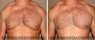 Before and After Treatment Photos: 39 year old Male 