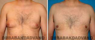 Before and After Treatment Photos: Gynecomastia Surgery: 34 year old, patient