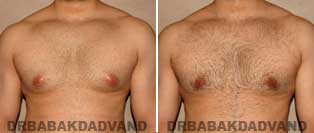 Before and After Treatment Photos: Gynecomastia Surgery: 28 year old, patient