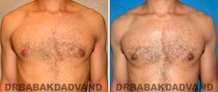 Before and After Treatment Photos.Gynecomastia Surgery - 27 year old, patient