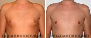 Before and After Treatment Photos.Gynecomastia Surgery - 28 year old, patient