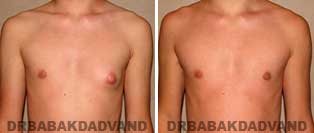 Before and After Treatment Photos: 16 year old Male
