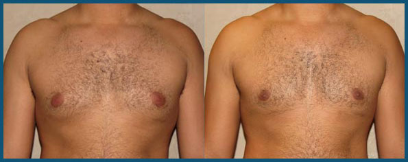 REVISION GYNECOMASTIA SURGERY before and after photo 1