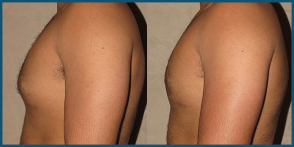 REVISION GYNECOMASTIA SURGERY before and after photo 2