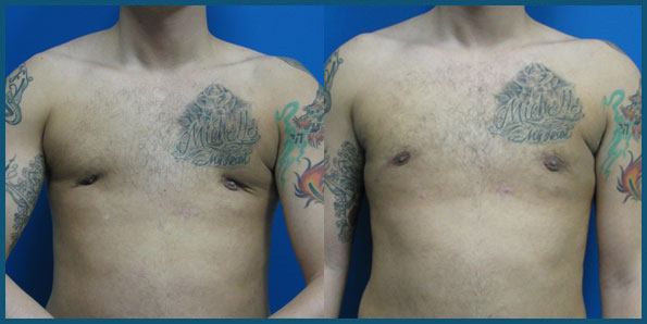 REVISION GYNECOMASTIA SURGERY before and after photo 3