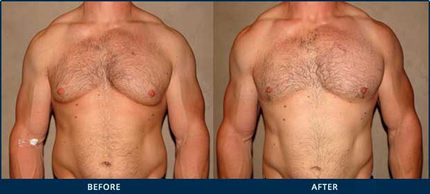 GYNECOMASTIA AND STEROID USE - Before and After Photos