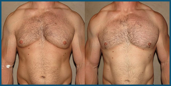 Gynecomastia Body Builders - Before and After Treatment Photo Patients
