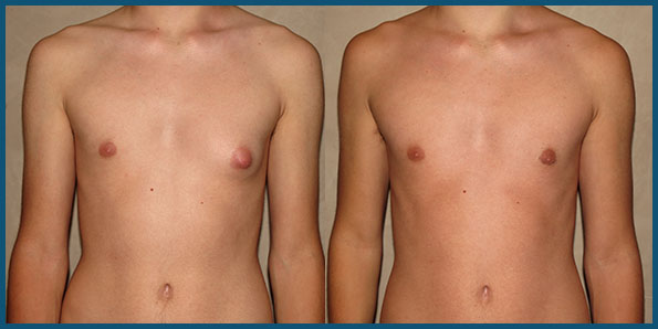 GYNECOMASTIA IN TEENS before and after photo