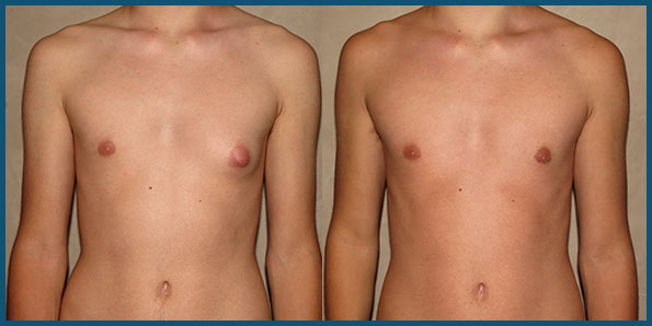 Gynecomastia Teen 106