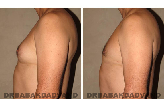 Gynecomastia. Before and After Treatment Photos - male, left side view (patient 37)
