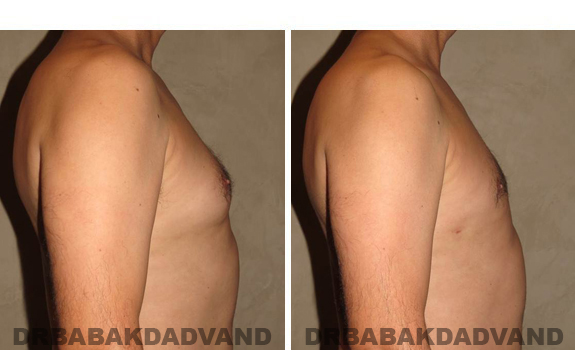 Gynecomastia. Before and After Treatment Photos - male, right side view (patient 37)