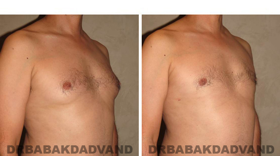 Gynecomastia. Before and After Treatment Photos - male, left side oblique view (patient 37)