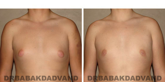Gynecomastia. Before and After Treatment Photos - male, front view (patient 38)
