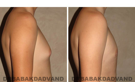 Gynecomastia. Before and After Treatment Photos - male, right side view (patient 38)