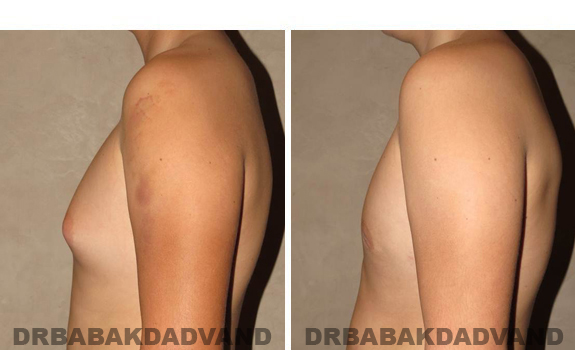 Gynecomastia. Before and After Treatment Photos - male, left side view (patient 38)
