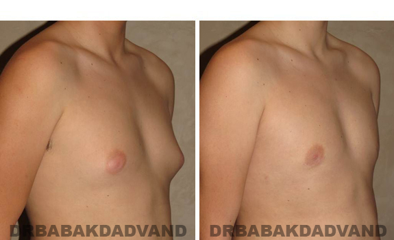 Gynecomastia. Before and After Treatment Photos - male, right side oblique view (patient 38)