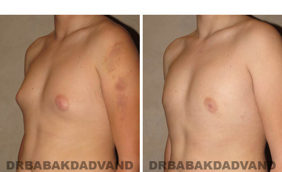 Gynecomastia. Before and After Treatment Photos - male, left side oblique view (patient 38)